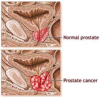 adenom de prostată stadiul 1)
