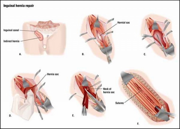 Operatia laparoscopica hernie ombilicala - Move&Flex