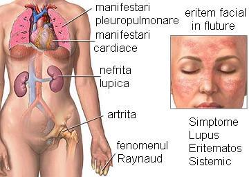 Timely Interpersonal yawning Lupus eritematos sistemic - simptome - DrBendo.ro
