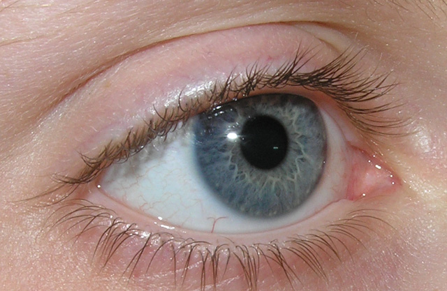 corp strain in ochi tratament)