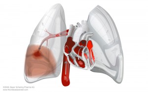 tromboembolism pulmonar embolie pulmonara