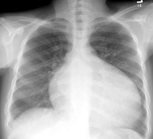 cardiomiopatie dilatativa radiografie toracica