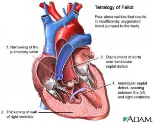 defecte inima in tetralogia Fallot