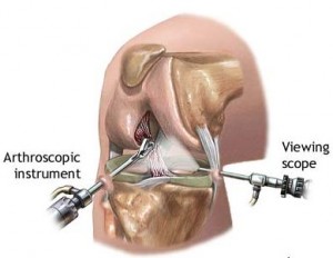 artroscopie genunchi ruptura menisc
